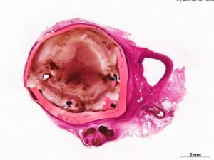 aneurysm occlusion device